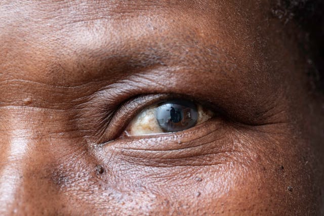 A closeup and macro view on the eye of an elderly black woman, a cloudy film is seen over the iris, symptomatic of a cataract, natural aging of the human eyes. (Adobe Stock / Alessandro Grandini)
