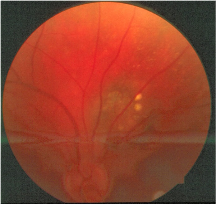 Figure 1. Color fundus photograph at baseline.The distinct borders of the slate-gray lesion are evident and even more distinct at clinical examination. The lesion itself extends just temporal to the retinal venule exiting the optic disc superiorly (broad arrow).