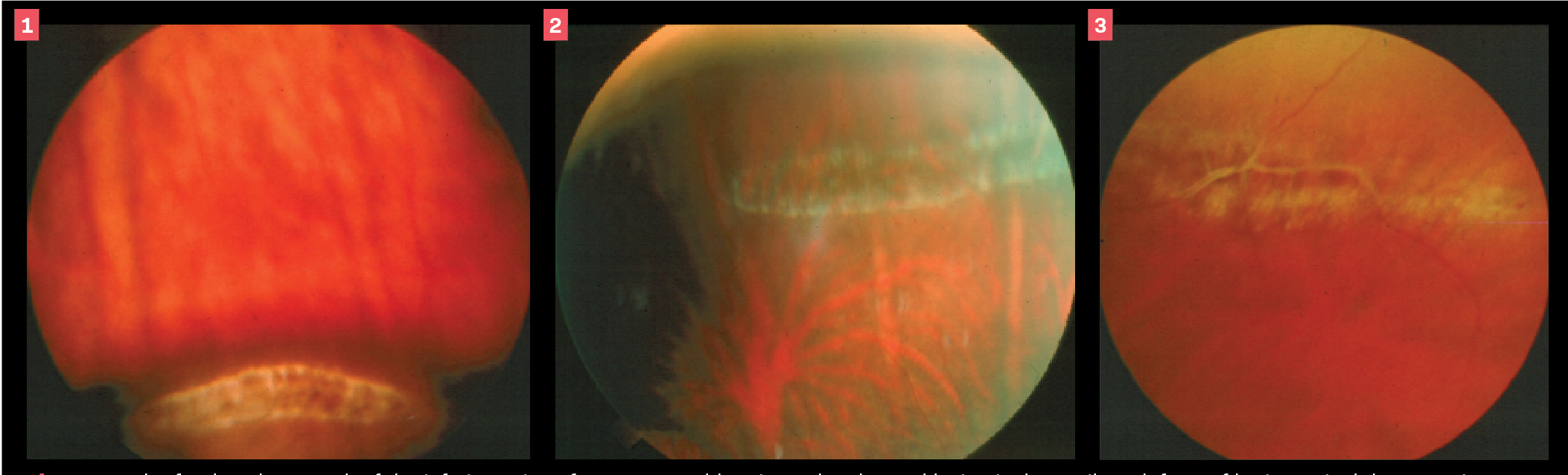 Figure 1. Color fundus photograph of the inferior retina of an 11-year-old patient. The elevated lesion is the snail-track form of lattice retinal degeneration on the prominence of a scleral indenter. The railroad-track feature at the left of the lesion is a short ciliary nerve.

Figure 2. Color fundus photograph of the superior retina of a 30-year-old patient. This another example of the snail-track form of lattice retinal degeneration. The vortex vein ampulla below the lesion shows that it is about 2 DD anterior. 

Figure 3. Color fundus photograph of the superior retina of a 65-year-old patient. This another an example of lattice retinal degeneration. The appearance of a whitened retinal vessel representing the vitreous adherence within the lesion. 

(Images courtesy of Leo Semes, OD)