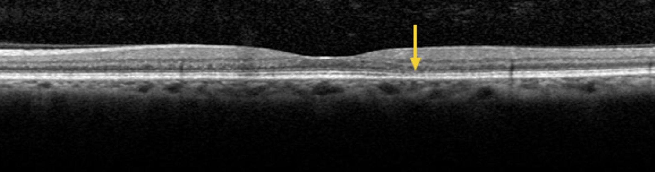 Figure 2. SD-OCT imaging of the left eye with the scan line adjusted to the area just below the fovea. Arrow points to a subtle area of attenuation of the ELM and IS/OS line.