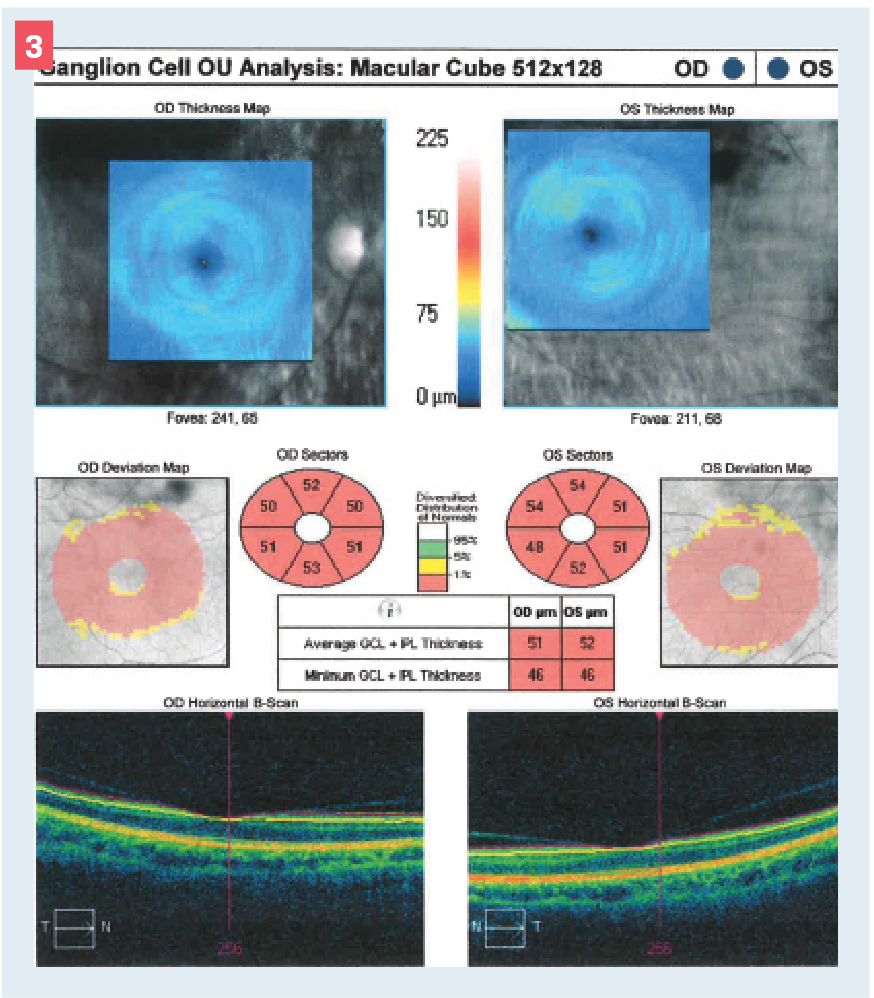 Figure 3. Optical coherence tomography thickness presentation of the ganglion cell analysis. Uppermost panels show extreme thinning based on the color scale. Blue color corresponds to less than 75 microns. The central panel shows significant inner retinal thinning based on the thickness map, as well as the absolute thickness values. The numbers in the 50-µm range represent significant neural tissue loss, leaving supporting structures only. The bottommost panel shows the horizontal cross sections demonstrating inner retinal nerve fiber layer thinning and obscuration of the normal foveal contour.