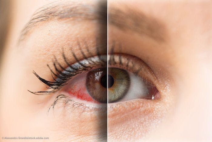 Novel drugs + delivery systems ease ocular pain and inflammation 