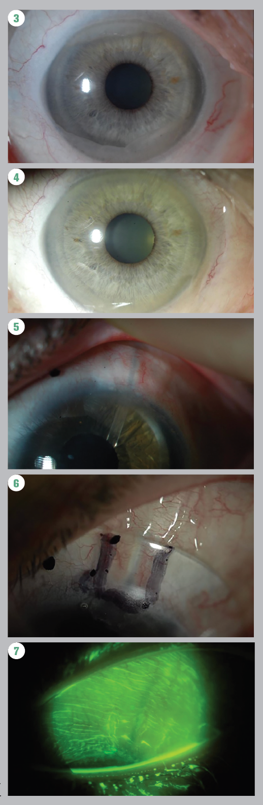 Figure 3. Conjunctival prolapse seen under scleral lenses.

Figure 4. Follow-up at 10 years with no cornea sequalae despite scleral lens fit with conjunctival prolapse.

Figure 5. Glaucoma Ahmed tube.

Figure 6. Scleral lens fit with a channel to accommodate tube.

Figure 7. No staining on tube observed after scleral lens wear.