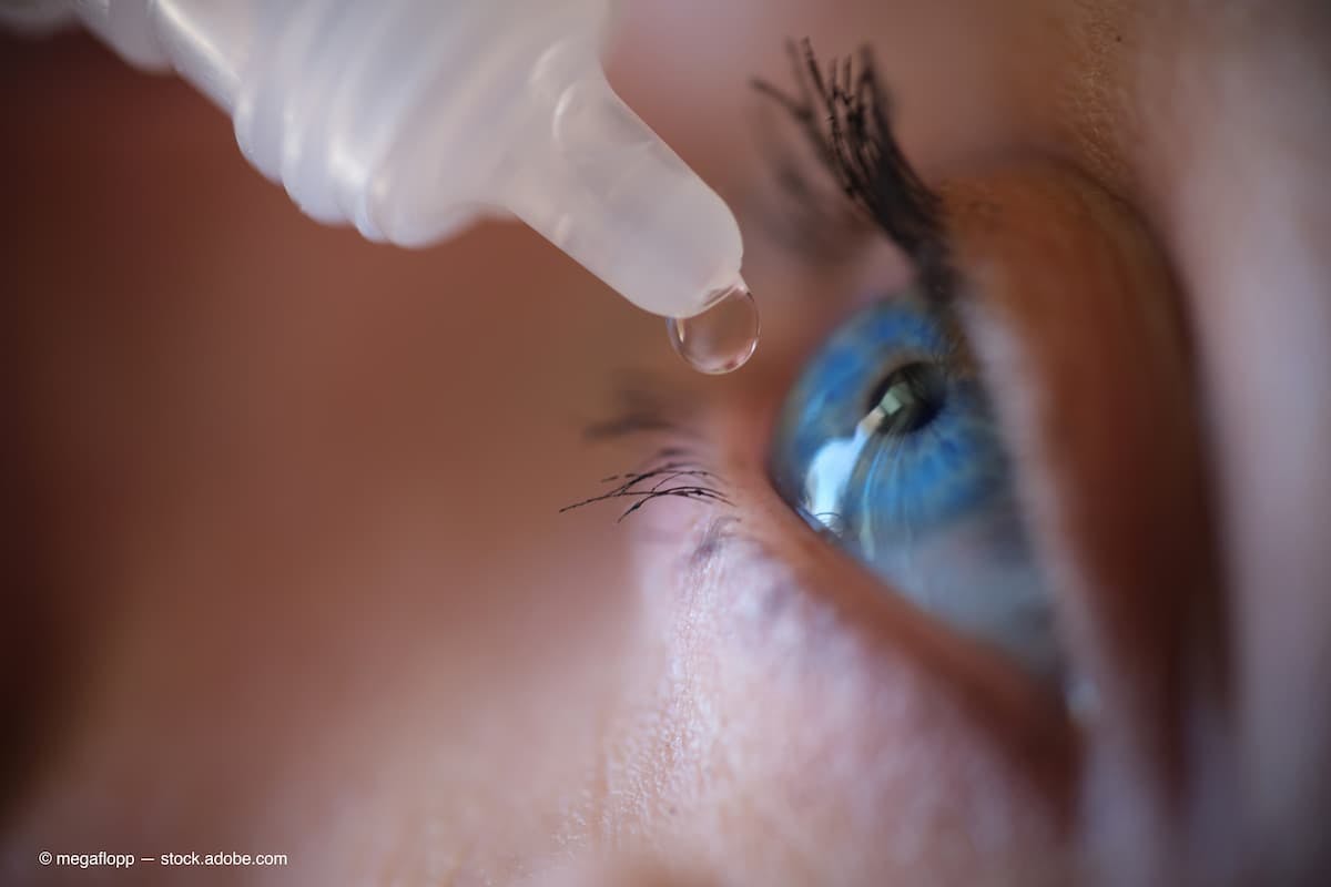 Woman applying eye drops to eye closeup (Adobe Stock / megaflopp)