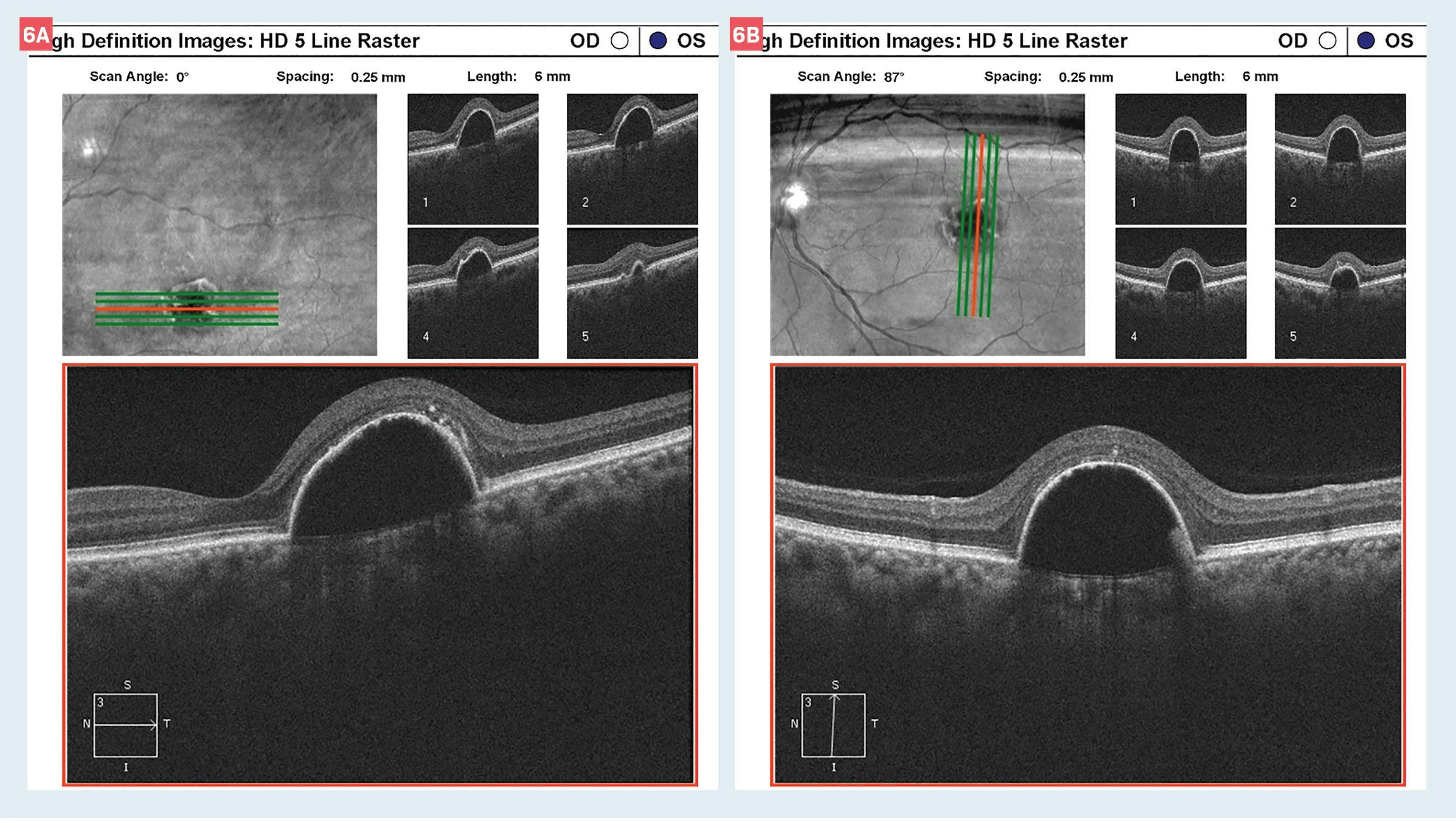 OCT corresponding to the most recent visit showing atrophy of the overlying RPE allowing less obscuration of the serous fluid. Note that the visible macula in the left panel shows intact outer retinal laminations consistent with the preservation of 20/20 VA.
