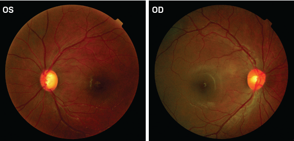 Case report: 16-year-old presents with asymptomatic glaucoma