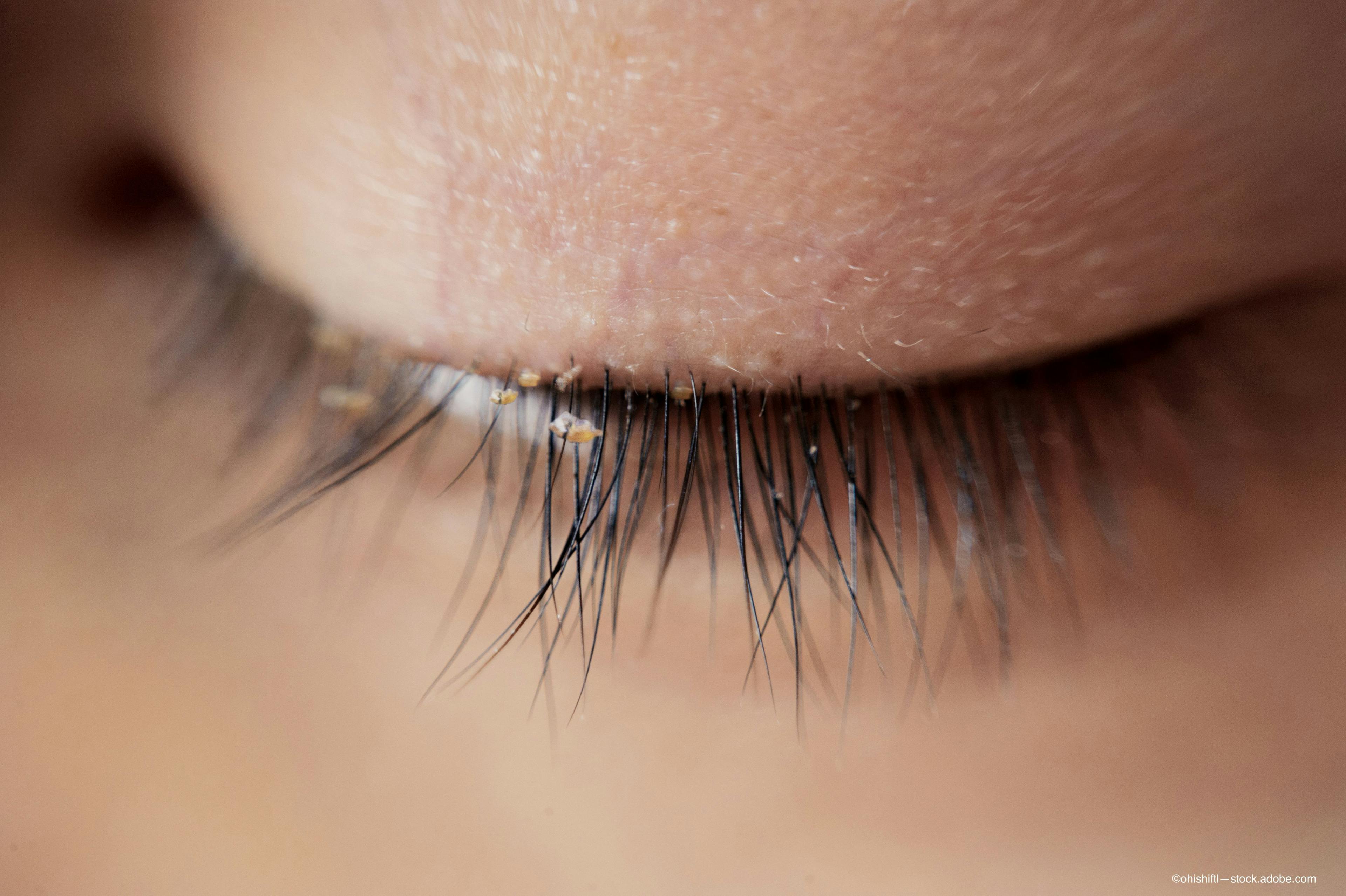 Collarettes on eyelashes indicate Demodex mites and Meibomian Gland Disease which can be treated with lotilaner ophthalmic solution under investigation by Tarsus - Image credit: Adobe Stock /ohishiftl