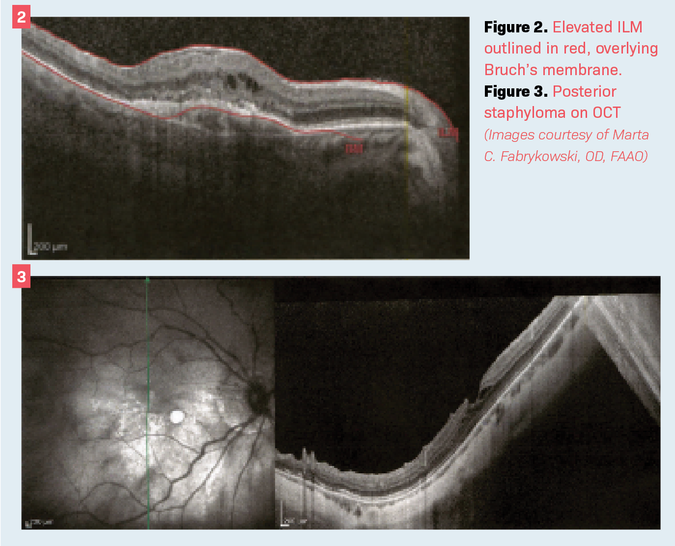 Retinal considerations crucial for accurate biometry
