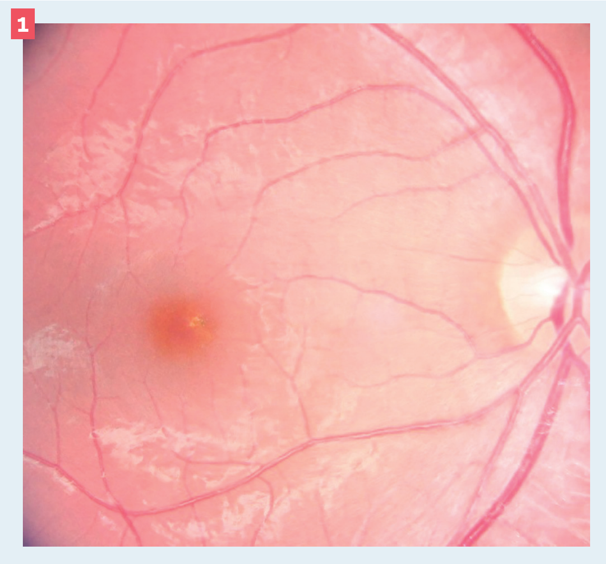 Figure 1. Color fundus photo of the right eye