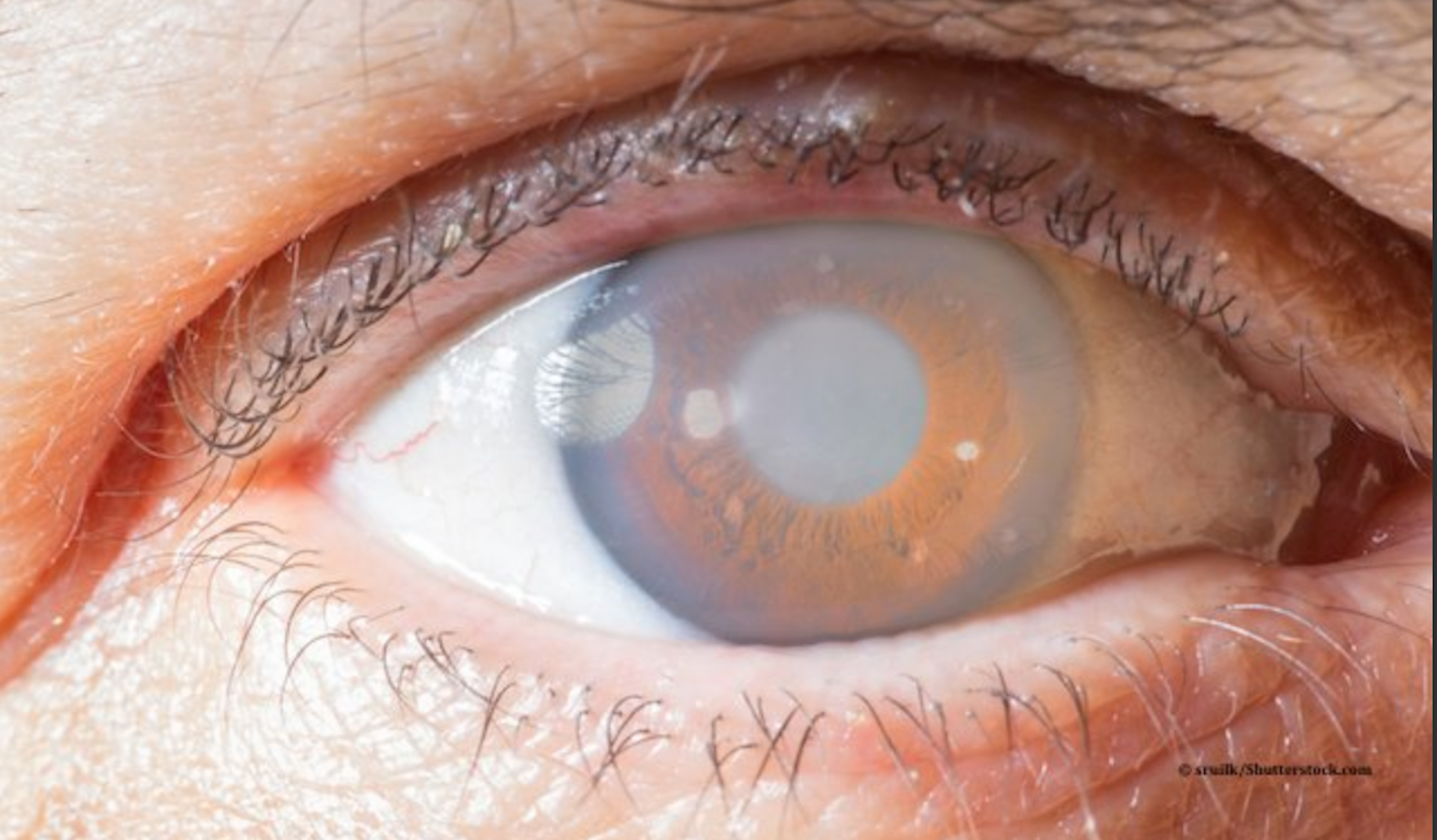 OCT helps diagnose retinoschisis in glaucoma patients 