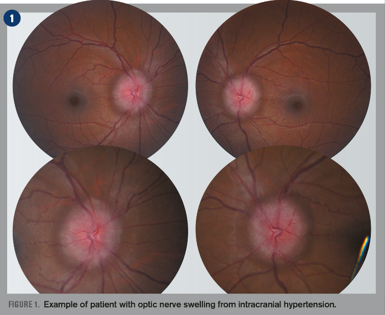  How to diagnose a swollen optic nerve 