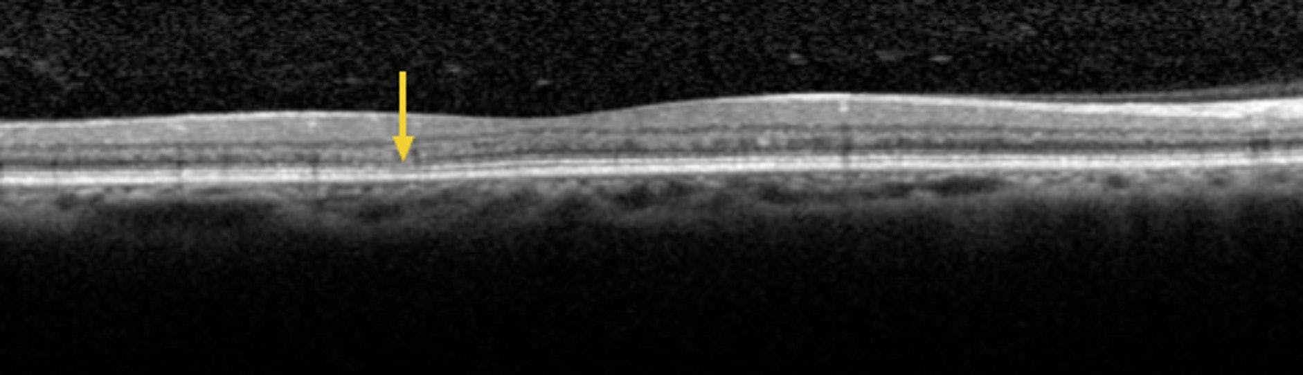 Figure 1. Spectral-domain optical coherence tomography (SD-OCT) of the right eye with scan line adjusted to area just below the fovea. Arrow points to subtle area of attenuation of the external limiting membrane (ELM) and inner segment/outer segment (IS/OS) line.