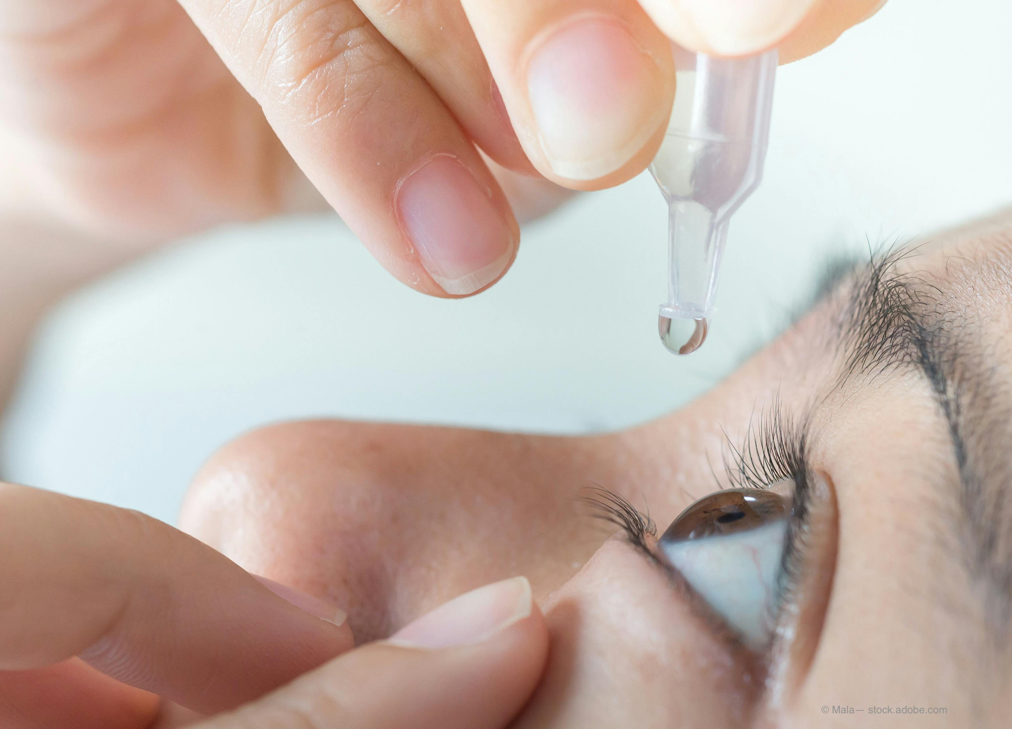  Aerie Pharmaceuticals announced Tuesday that the first participant has been dosed in the phase 3 registrational “COMET-2” study evaluating AR-15512 ophthalmic solution for the treatment of dry eye disease (DED).