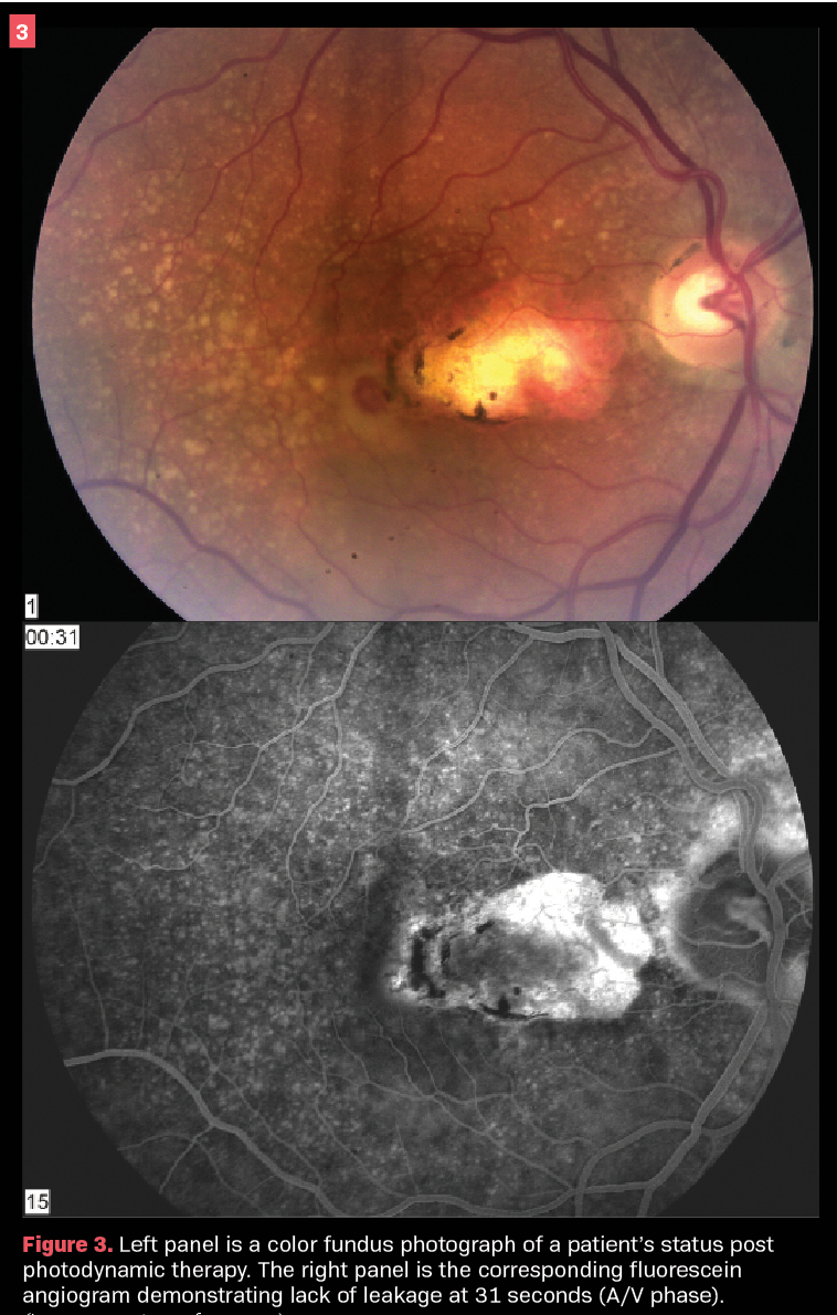 Figure 3. Left panel is a color fundus photograph of a patient’s status post photodynamic therapy. The right panel is the corresponding fluorescein angiogram demonstrating lack of leakage at 31 seconds (A/V phase). 