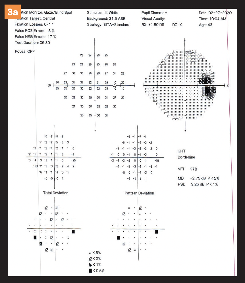 Figure 3 a/b. Slight enlargement of the blind spot OU.