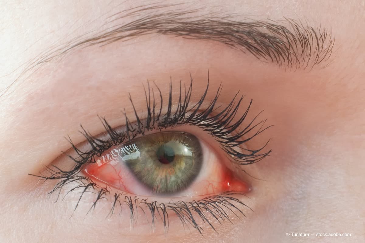 Red irritated human eye close up, allergy symptom (Adobe Stock / Tunatura)