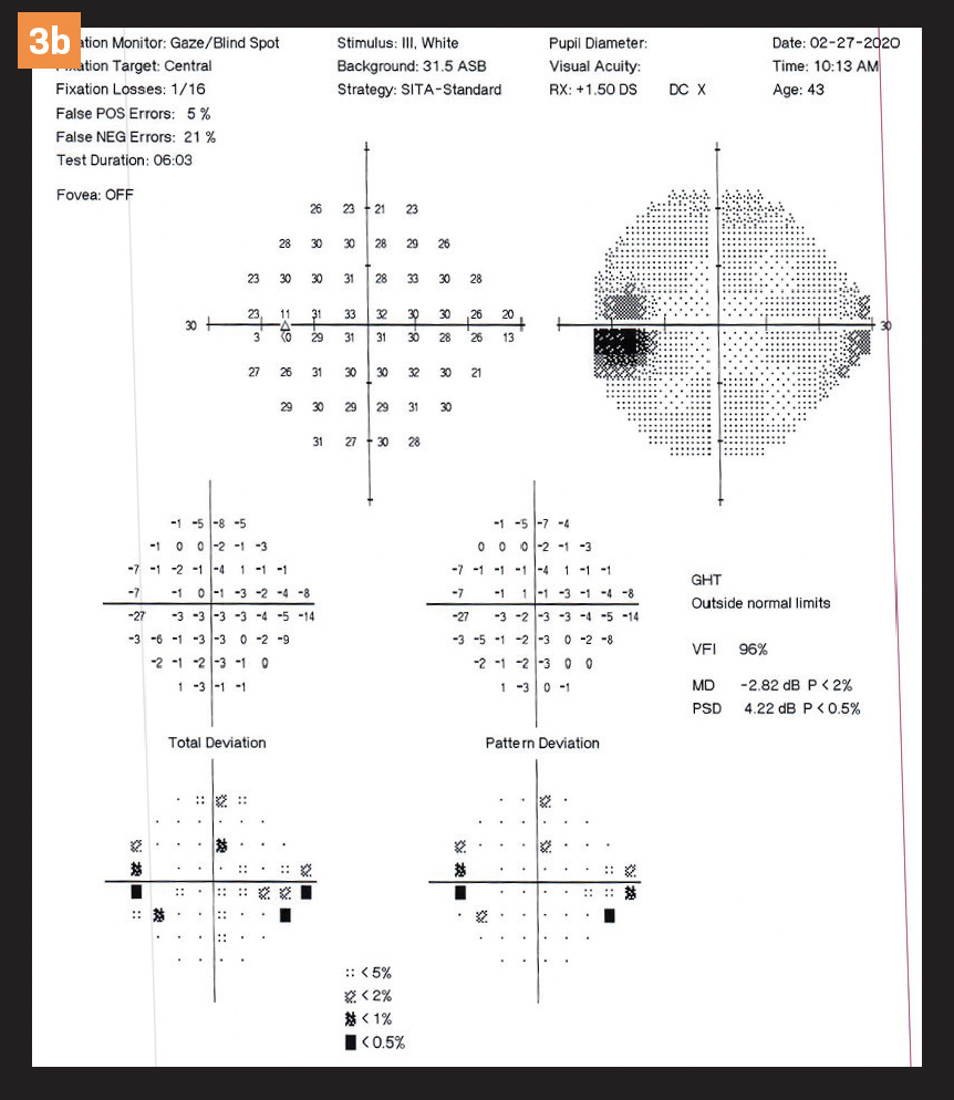 Figure 3 b. Slight enlargement of the blind spot OU.