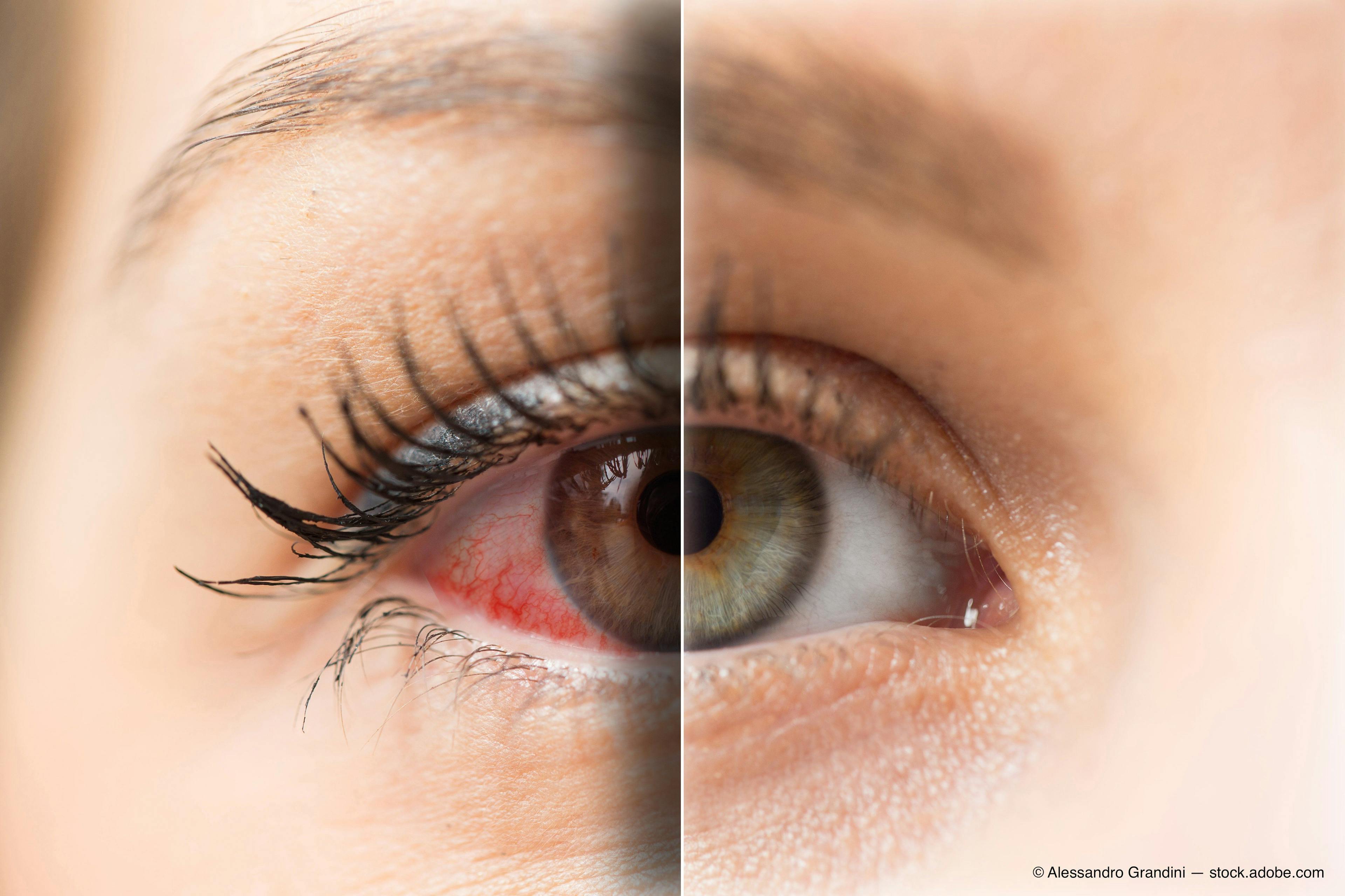 Blog: Don't leave dry eye disease patients high and dry