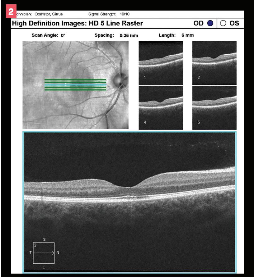Figure 2. Optical coherence tomography (OCT) of the right eye.