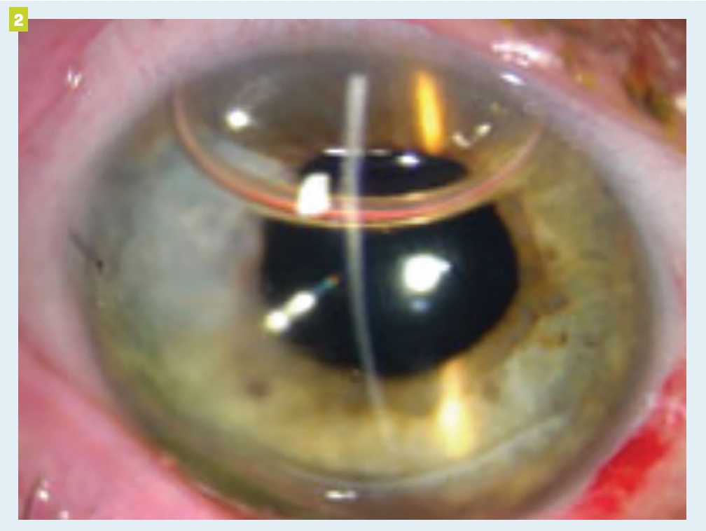 Figure 2: An example of an anterior chamber air tamponade bubble adhering to the tear of Descemet membrane and positioning in the superior anterior chamber.12 

(Images courtesy of Thomas John, MD.)