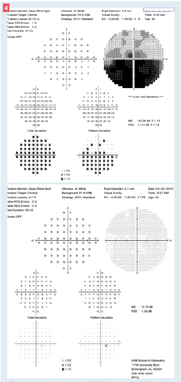 Figure 4: Central 10° visual field results. The left panel is the left eye, and the right panel is the right eye. Consistent with visual acuity, the right eye is clear. The left eye shows significant inferior depressions within the central area. This is again consistent with visual acuity. 