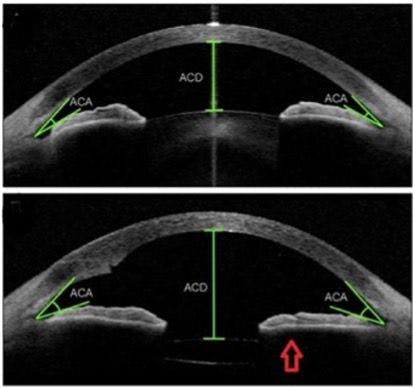 Figure 2. Anterior segment OCT demonstrating how lens extraction opens the anterior chamber angle (ACA), preventing iridolenticular contact and eliminating the release of pigment from obstructing the trabecular meshwork.