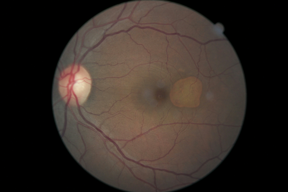 2-year follow-up CFP of the left eye showing progressive RPE atrophy with relatively stable area.