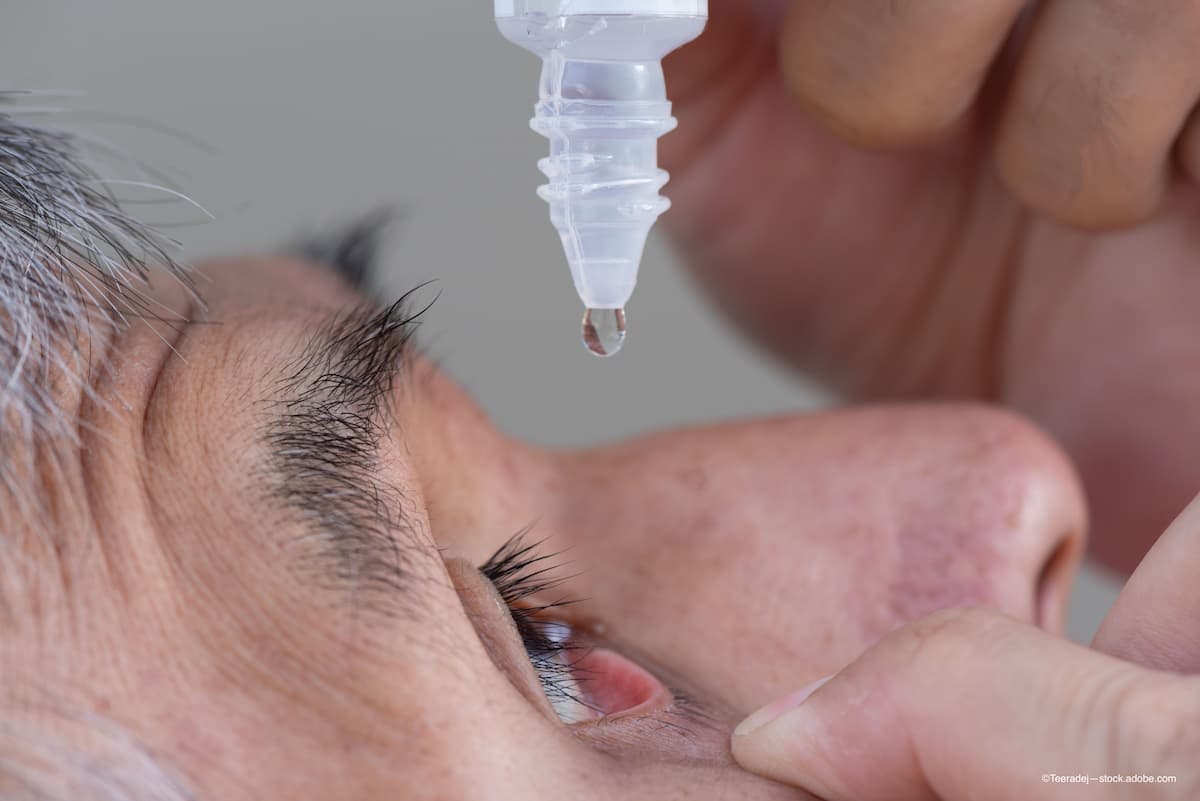 Presbyopia eye drops administered twice daily per FDA | Image Credit: ©Teeradej - ©Teeradej - stock.adobe.com