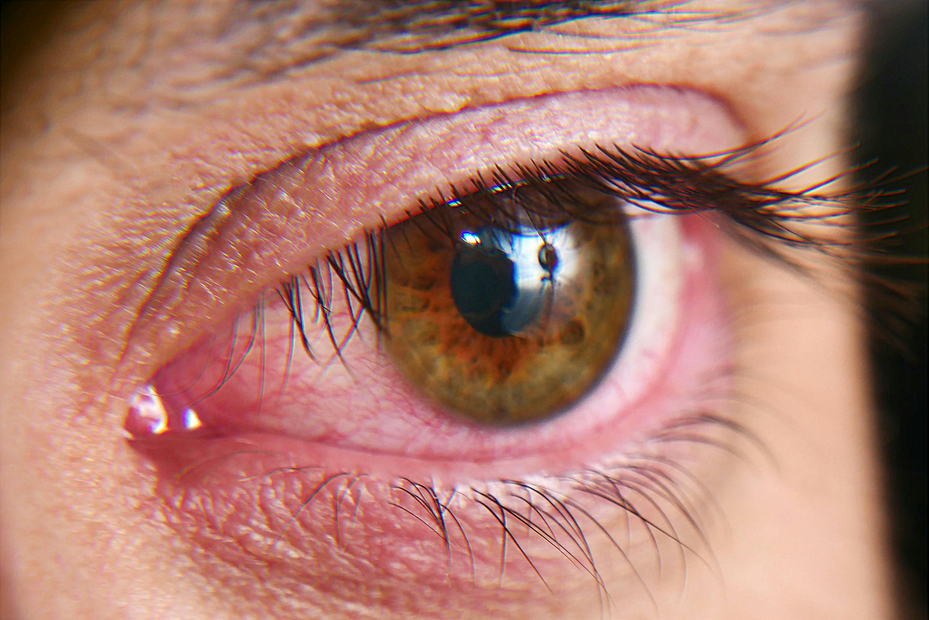 New therapy addresses dry eye flares