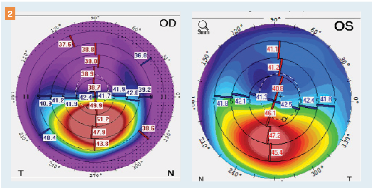 Figure 2. A 28-year-old male patient was referred for keratoconus in the right eye despite seeing 20/20 uncorrected. After examination, keratoconus was diagnosed in both eyes. (Images courtesy of William B. Trattler, MD)