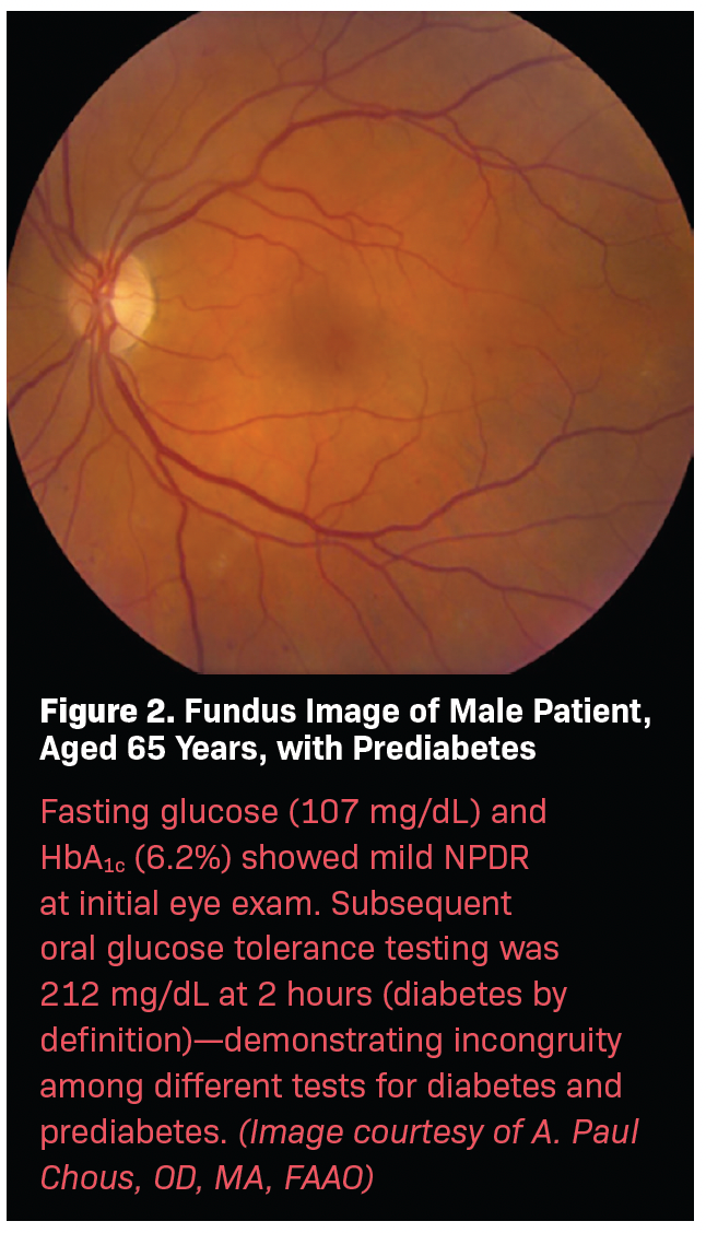 Figure 2. Fundus Image of Male Patient, Aged 65 Years, With Prediabetes