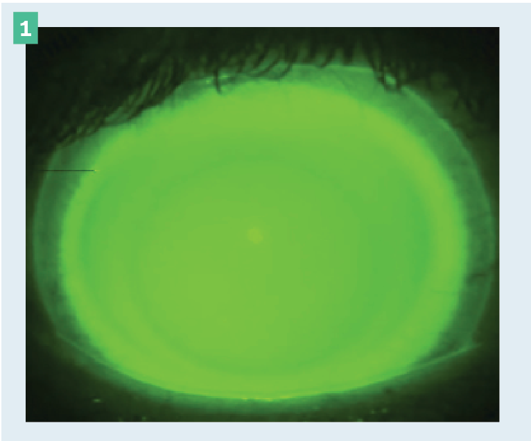 Figure 1. Scleral lens demonstrating appropriate apical and limbal clearance.