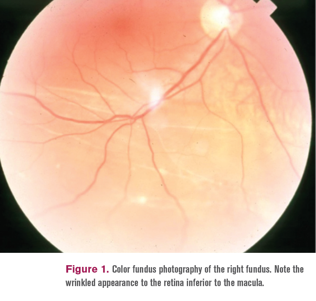 When a retinal detachment isn’t a retinal detachment