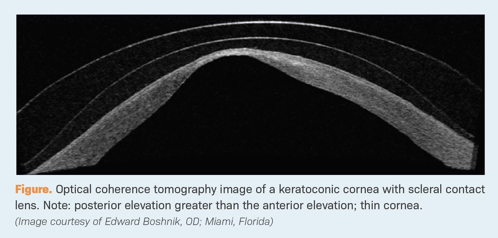 Optical coherence tomography image of a keratoconic cornea with scleral contact lens. Note: posterior elevation greater than the anterior elevation; thin cornea.