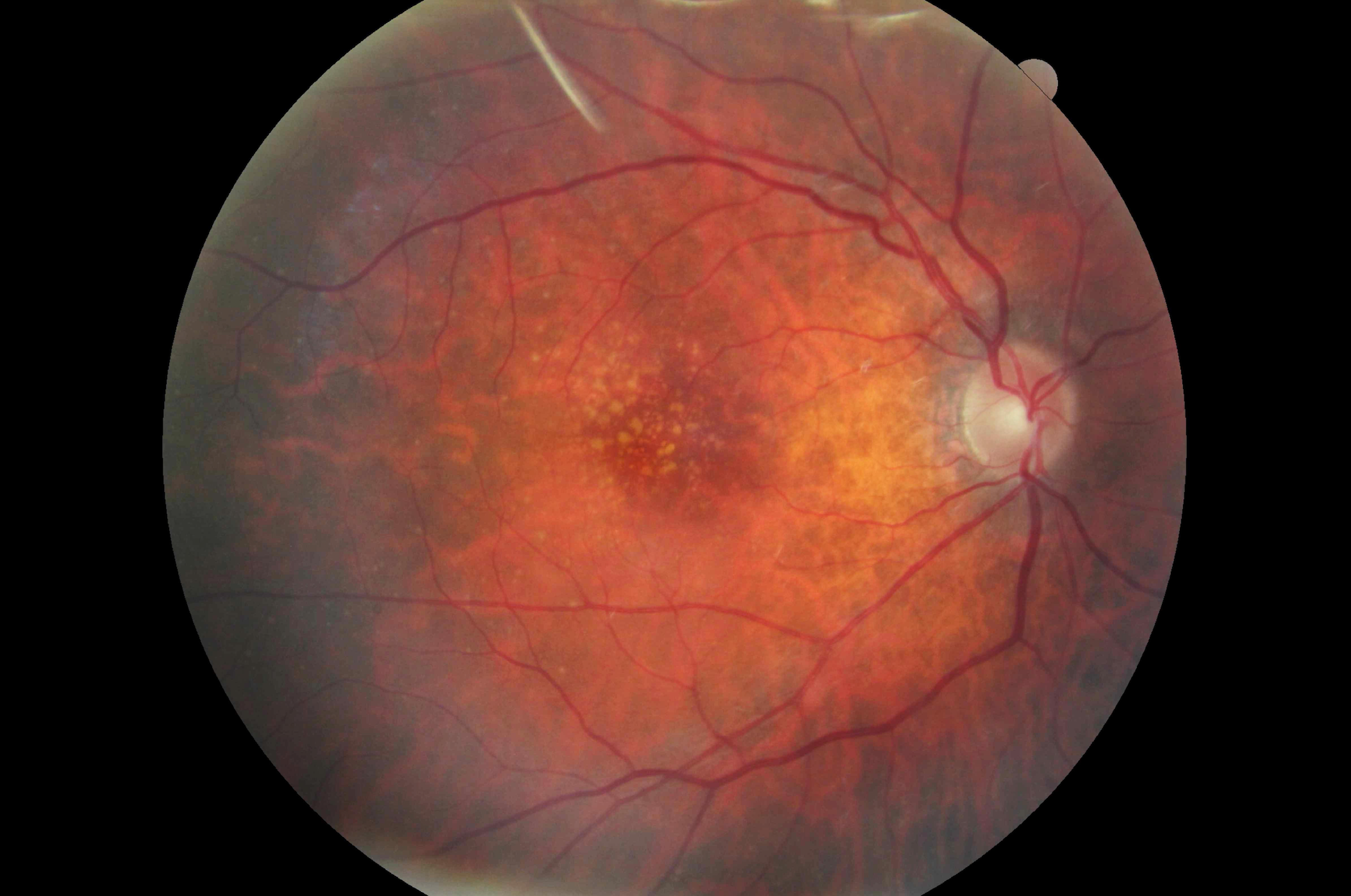 Why doctors are rethinking AMD standards