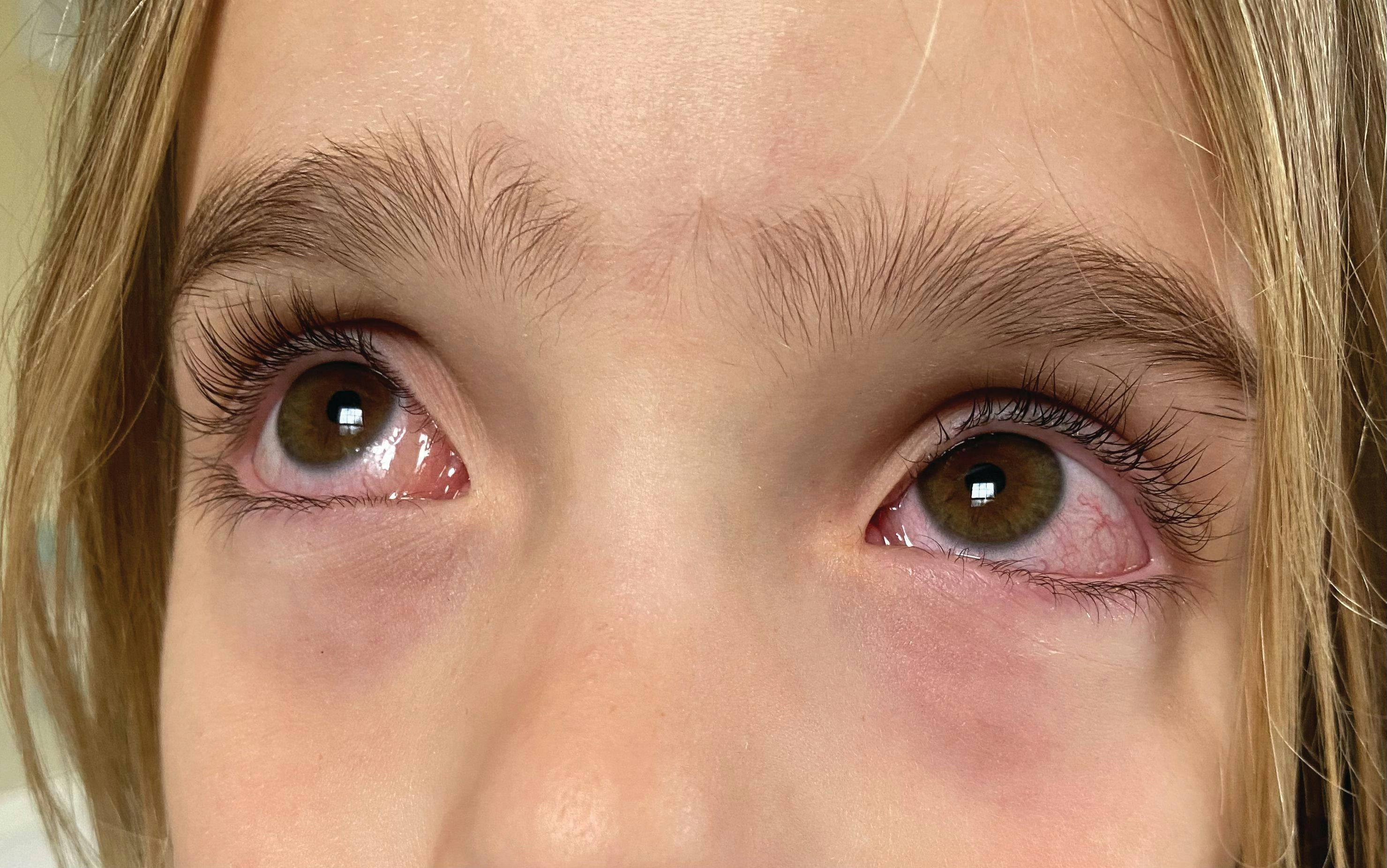 Allergic conjunctivitis is prevalent in youngsters