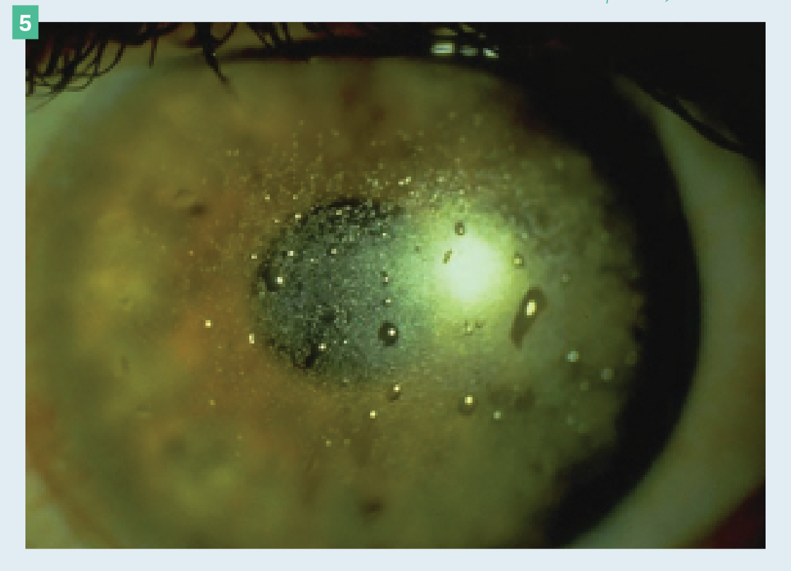 Figure 5. Scleral lens demonstrating poor wetting on the front surface.

(Images courtesy of Ashley Tucker, OD, FAAO, FSLS, Dipl ABO)