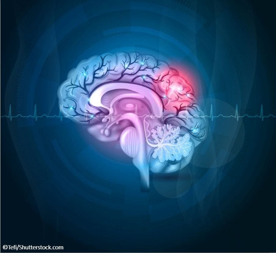 brain image of stroke