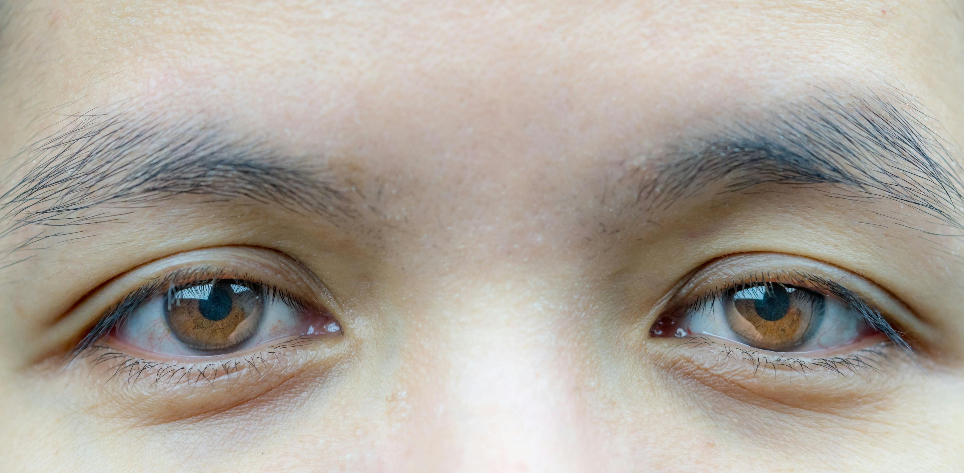 Anophthalmic ptosis and enucleation effects on upper eyelid function