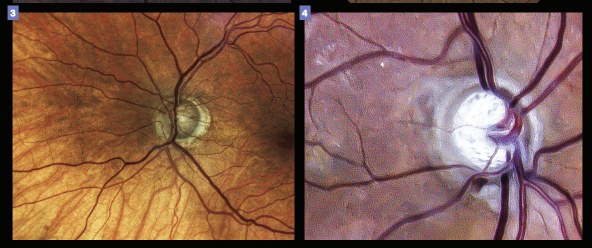 Figure 3. Presence of an optic disk hemorrhage could indicate future progression. Figure 4. Such risk of future disease progression may indicate the need for a more aggressive treatment. (Images courtesy of Gleb Sukhovolskiy, OD)
