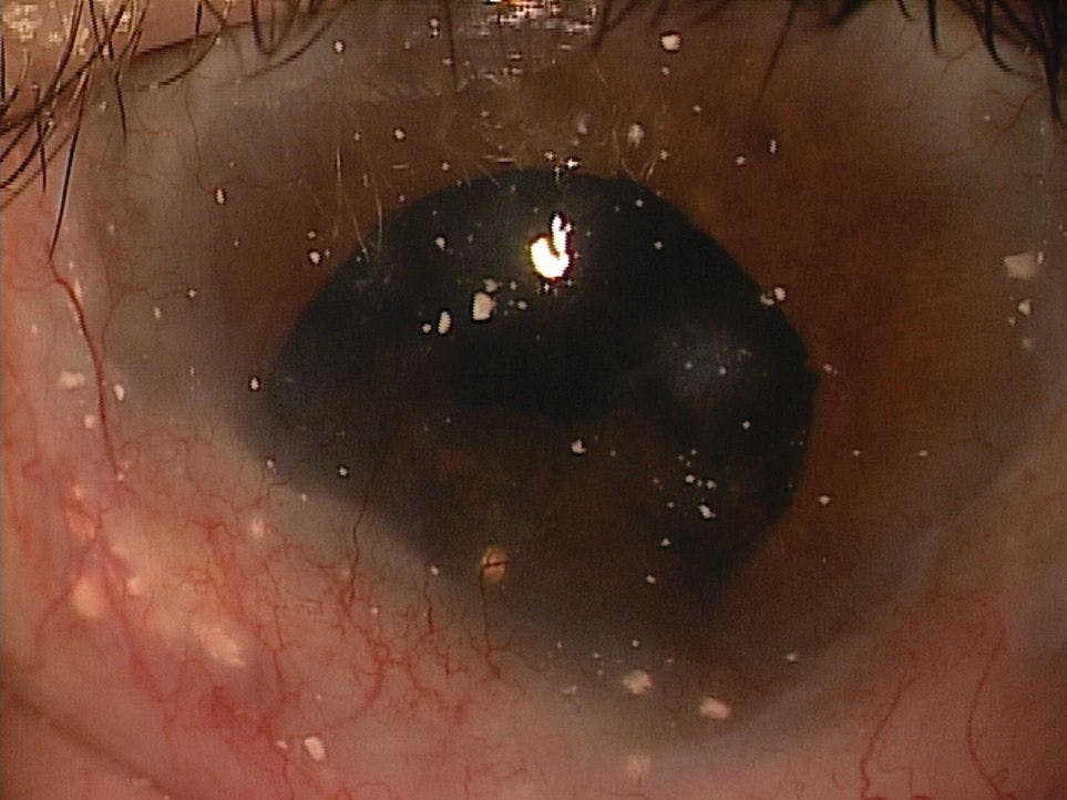 Corneal topography of a highly irregular cornea.