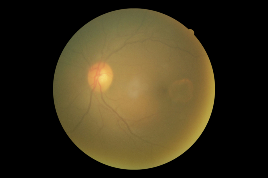 4-year follow-up OCT shows lens opacity that obscures the retinal features as well as changes in the overlying retinal pigmentary changes but stability of the lesion.