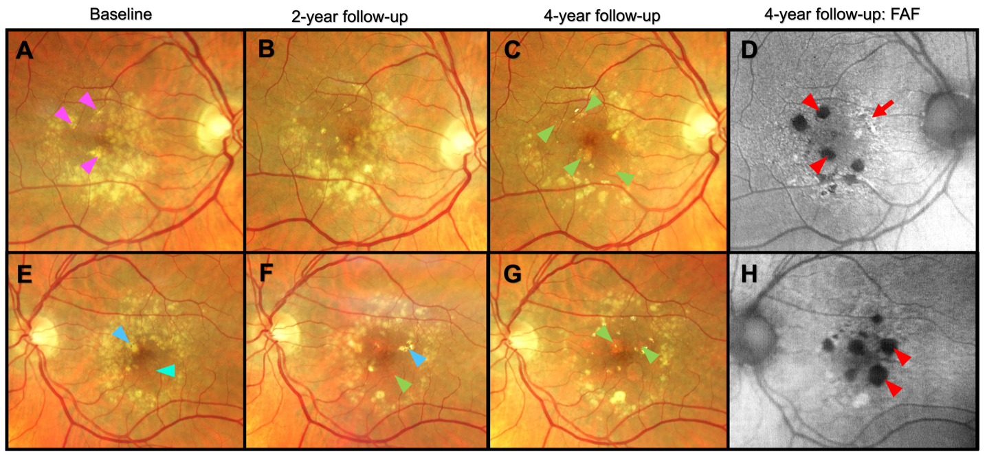 Figure 4. Color fundus photography showing development and progression of geographic atrophy (GA) in the right and left eyes over 4 years. A & E: Baseline. B & F: 2-year follow-up. C & G: 4-year follow-up. D & H: Fundus autofluorescence imaging (FAF) at the 4-year follow-up. Top row: Right eye: Baseline color fundus photography demonstrates extensive confluent soft drusen with several refractile areas (A, pink arrowheads). Sequential follow-up demonstrates regression and collapse of drusen with the development of several areas of extrafoveal GA (C, green arrowheads). FAF imaging at the 4-year follow-up demonstrates hypo-autofluorescence corresponding to areas of GA (D, red arrowheads), and a ring of perifoveal hyper-fluorescence (D, red arrow). Bottom row: Left eye: Baseline color fundus photography demonstrates extensive confluent soft drusen relatively sparing the inferior temporal
perifovea. Hyperpigmentation is appreciated in the superior nasal parafovea (E, blue arrowhead). An area of increased choroidal visibility (E, teal arrowhead) is noted in the inferior temporal parafovea. Sequential follow-up demonstrates collapse and regression of drusen and the development of extrafoveal GA (F & G, green arrowheads). FAF imaging at the 4-year follow-up demonstrates hypo-autofluorescence corresponding to areas of GA (H, red arrowheads). Speckled areas of hyper-autofluorescence are appreciated throughout the perifoveal area and at the margin of GA. (Figures courtesy of Ethan Wohlgemuth, OD)
