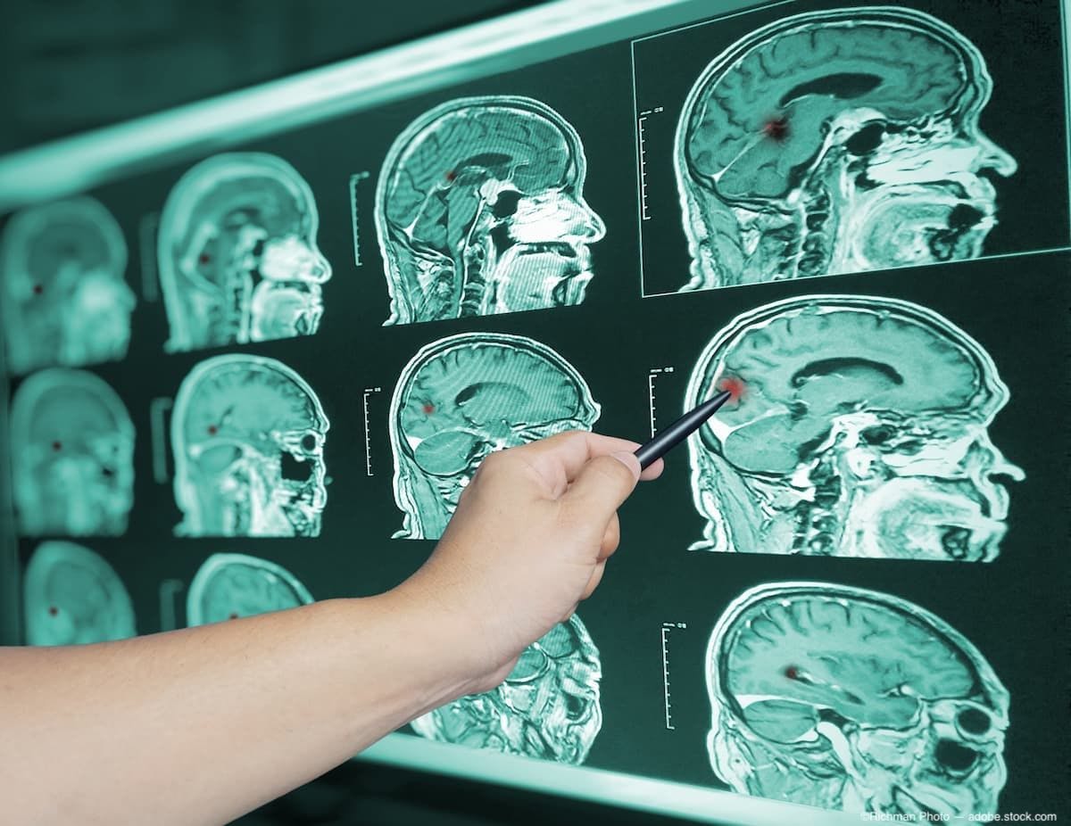 Hand holding pen pointing to brain scan of traumatic brain injury Image credit: AdobeStock/Richman Photo