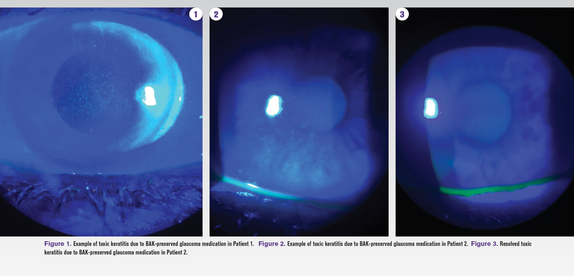 Glaucoma & ocular surface preservation: Key factors for ODs to consider