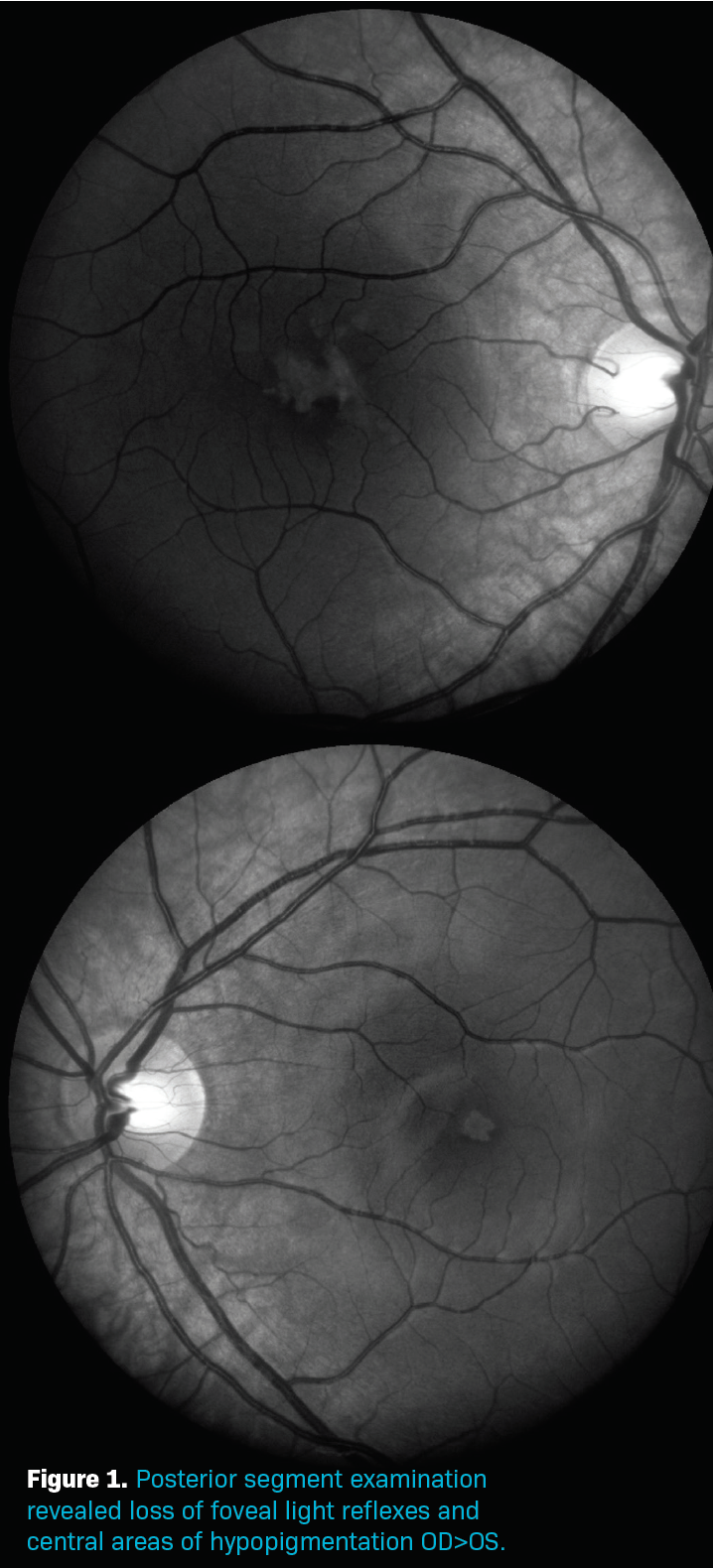 CASE REPORT: Self-induced maculopathy by 12-year-old boy