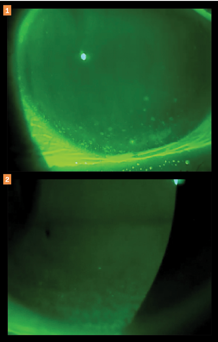 Figure 1. A 42-year-old patient presented with inferior corneal staining but negative InflammaDry (Quidel) test readings upon examination.  Figure 2. Between 3 and 4 weeks following treatment of a new-generation artificial tear containing hyaluronic acid, trehalose, and povidone, the patient’s tear film had stabilized and fully resolved her corneal staining and focusing problems.   (Images courtesy of Mile Brujic, OD, FAAO)