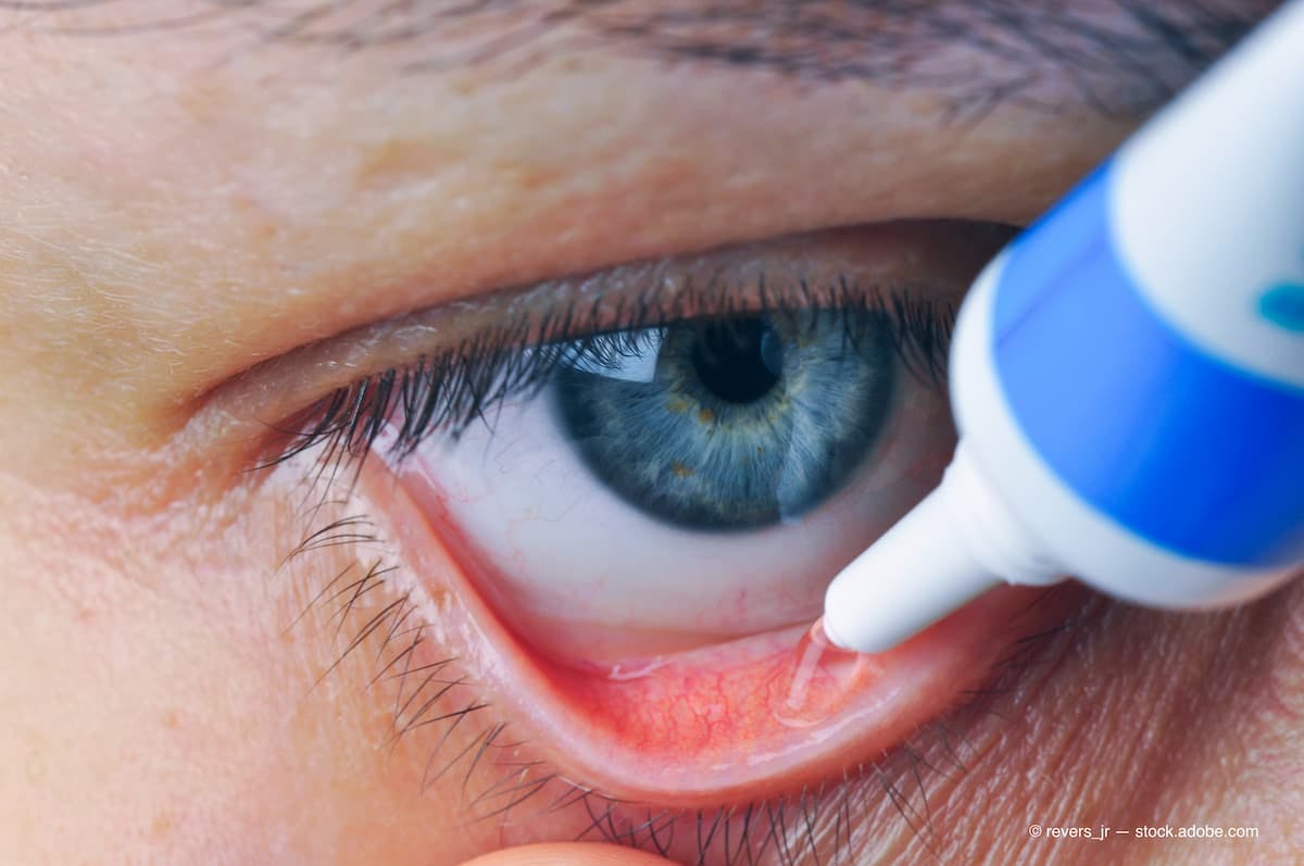 Second FDA warning issued on bacterially contaminated eye care products
