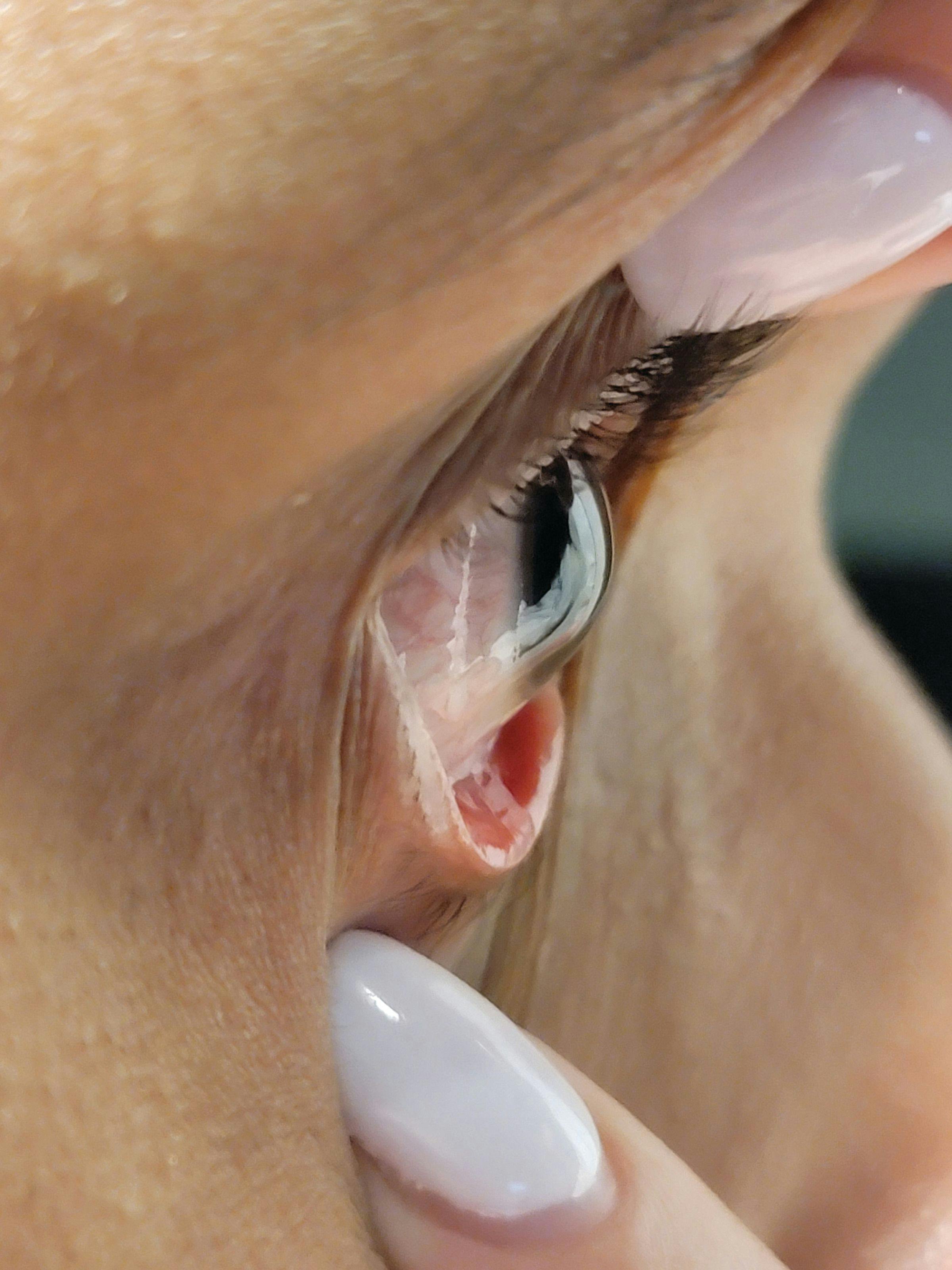 Figure 1. The profile viewing method of scleral lens fitting involves lifting the upper and lower lid and evaluating the overall scleral, allowing for the evaluation of the corneoscleral angle superiorly and inferiorly