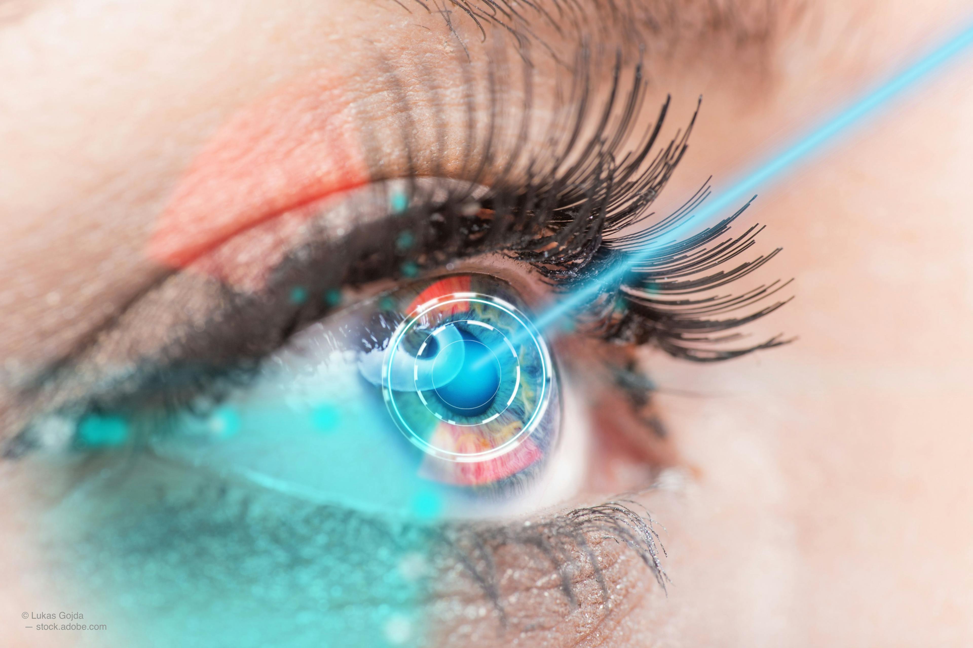 Evolution of in-office glaucoma surgical procedures